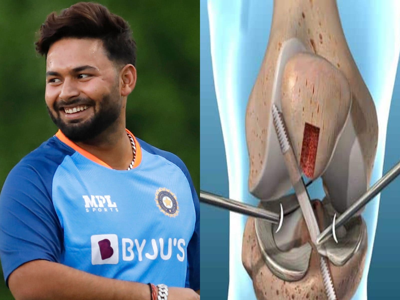Rishabh Pant to Undergo Ligament Tear Surgery; Know About Its Procedure and  Recovery Time - News18