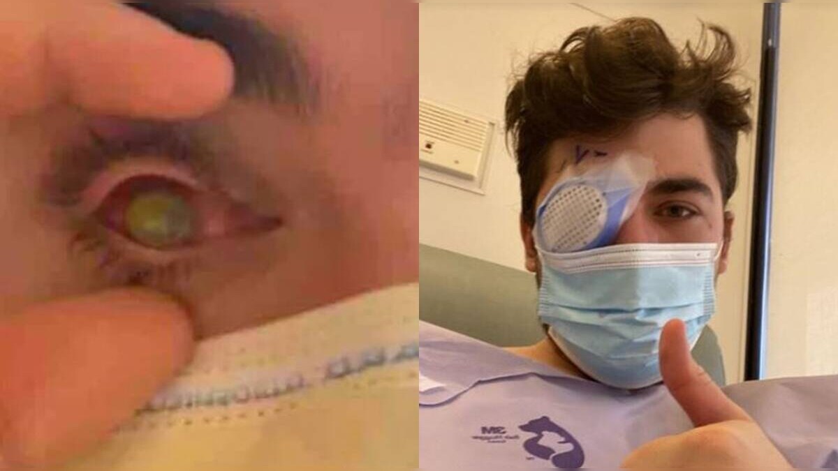 FleshEating Parasites Feed On a Man’s Eye After He Sleeps with Contact Lenses On News18