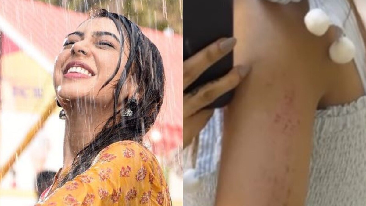 Bade Achhe Lagte Hain 2: Niti Taylor Gets Injured On Sets, Shares Pic of Her Bruised Arm