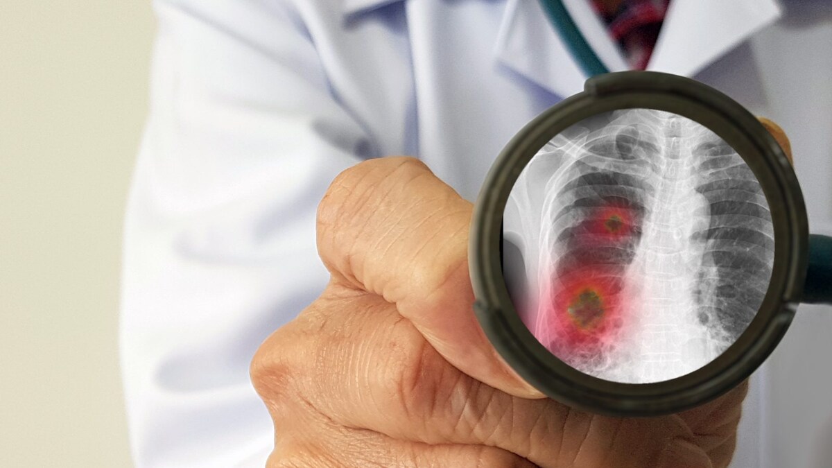 Know How To Spot First Signs Of Pneumonia