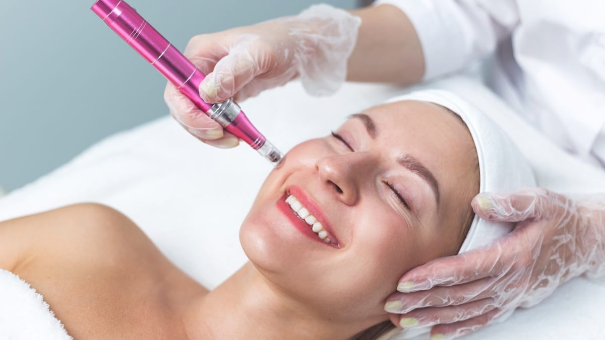 Can MicroNeedling Really Treat Acne Scars? Find Out