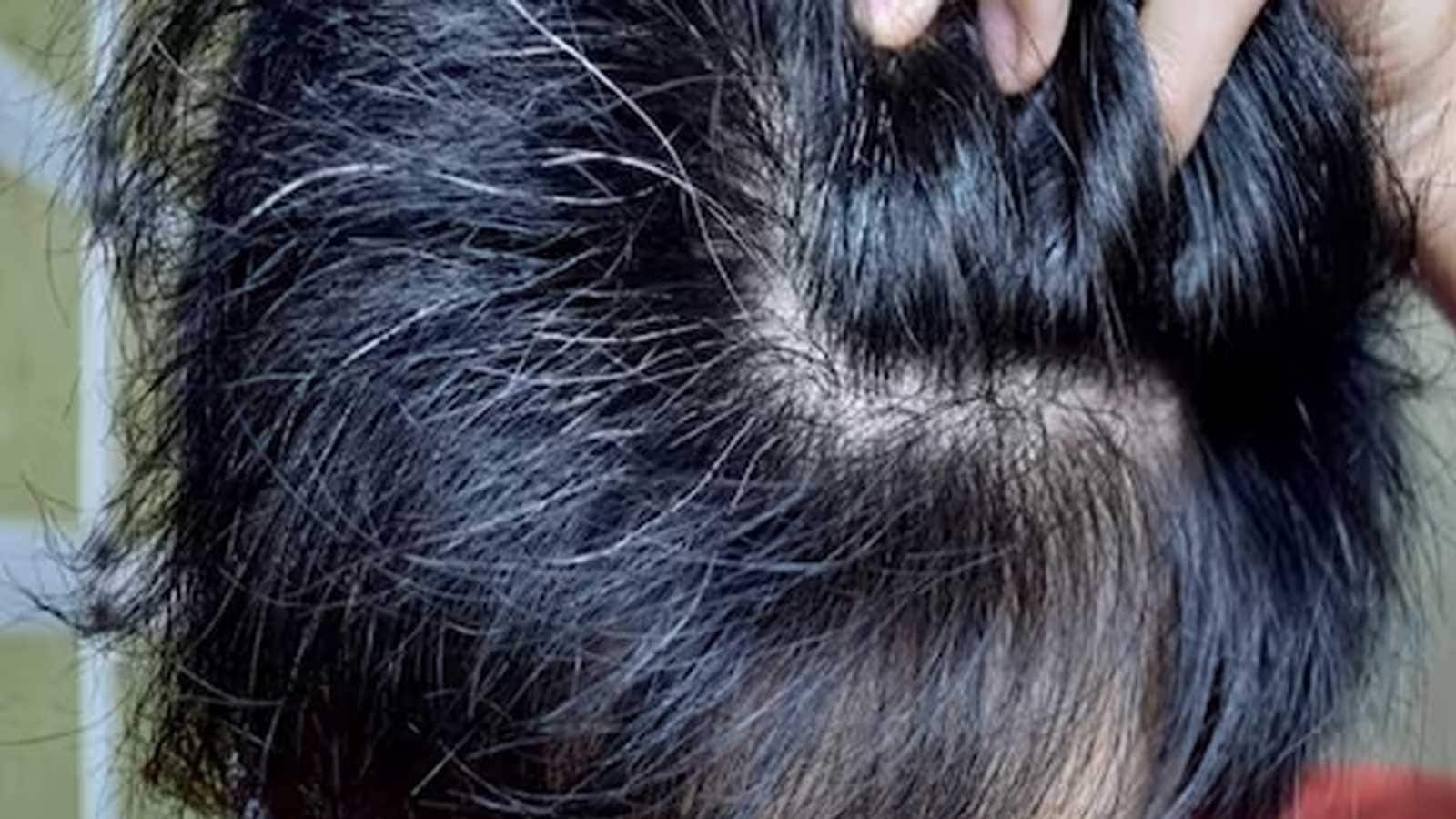 Home Remedies for Premature Hair Greying in Kids