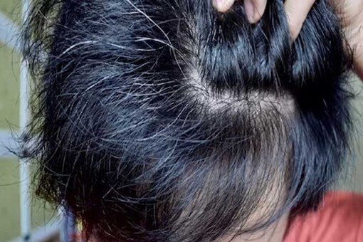 Home Remedies for Premature Hair Greying in Kids