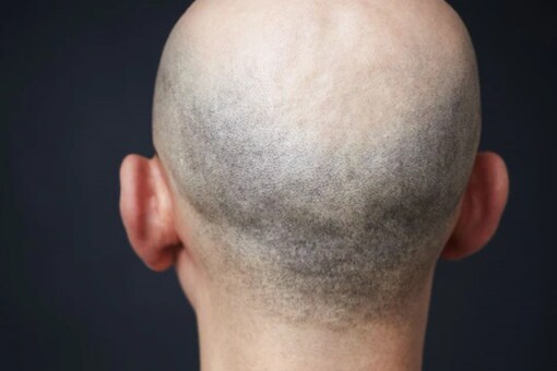 UK Man Wins Rs 70 Lakh Payout After He Faced Discrimination For Being Bald UK Man Wins Rs 70 Lakh Payout After He Faced Discrimination For Being Bald