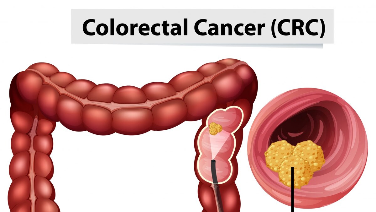 Colorectal Cancer: Early Screening, Prevention, Symptoms And Treatment ...