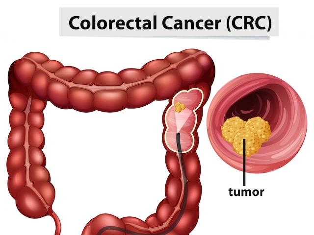 The American Cancer Society (ACS) recommends that people at average risk of colorectal cancer start regular screening at age 45