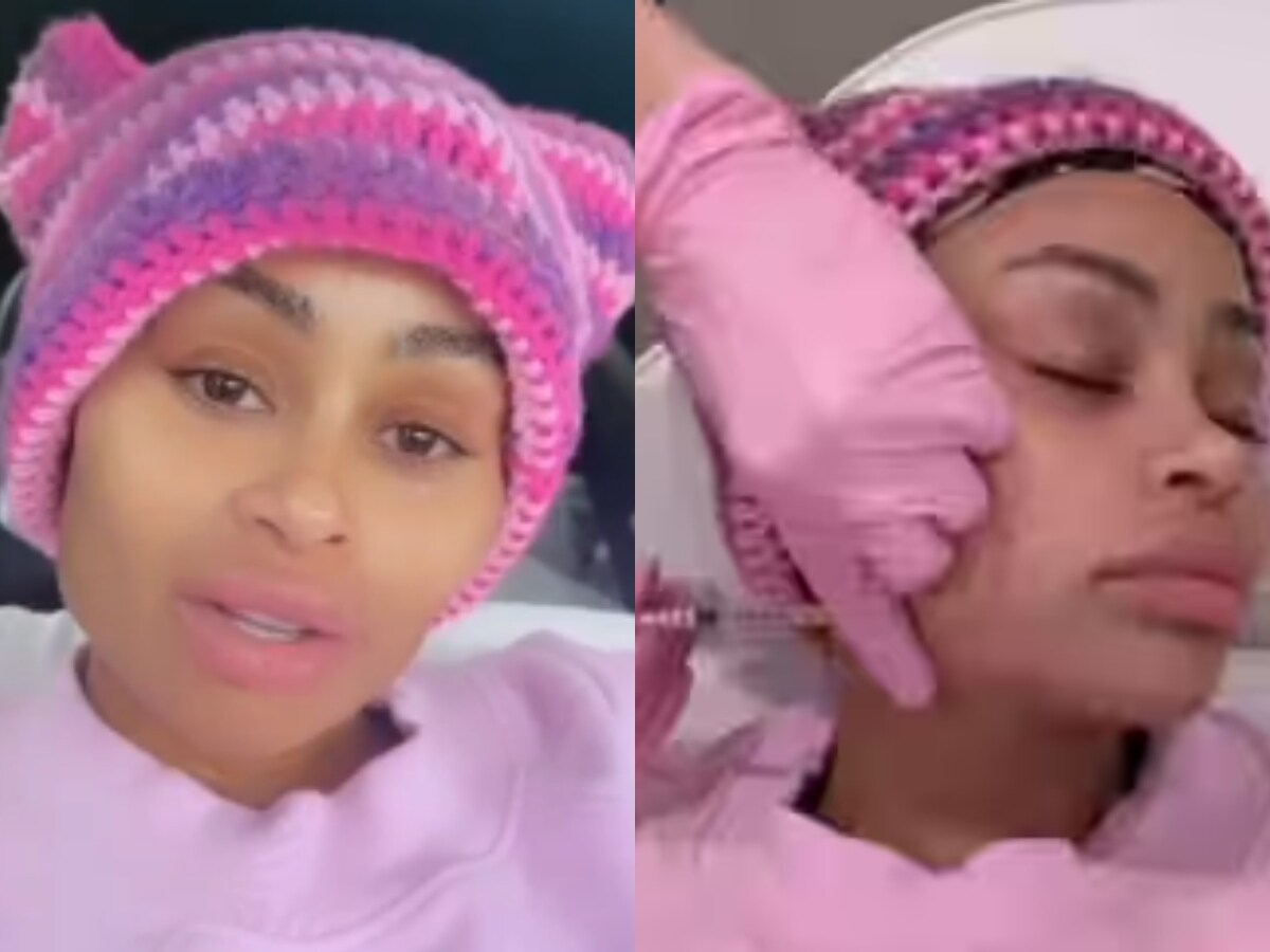 Blac Chyna Removes Facial Fillers After Breast and Butt Reduction