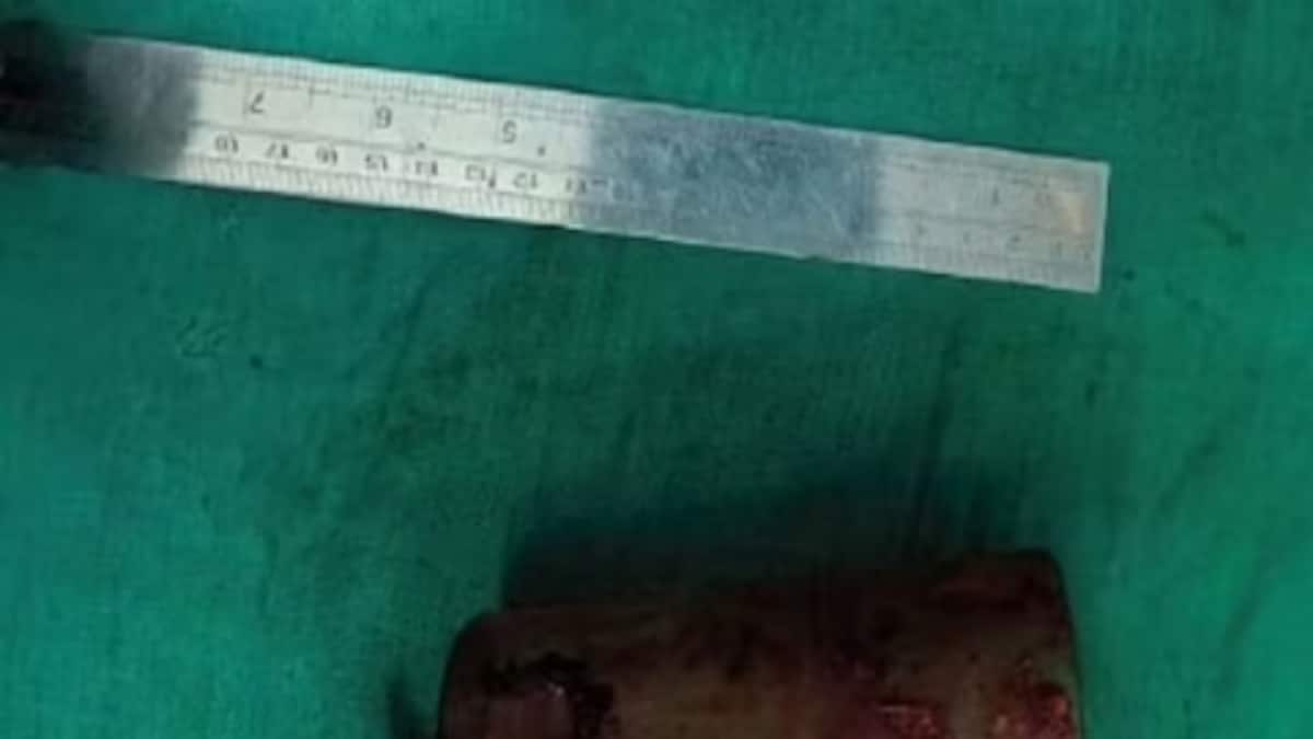 This Drunk Man Inserted 12 CM Long Glass Inside His Private Part for... - Vimarsana News