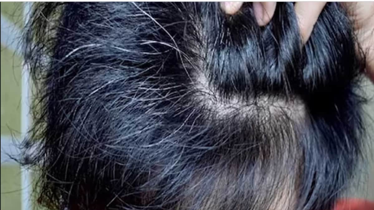 US Scientists Decode Why Our Hairs Turn Grey News18