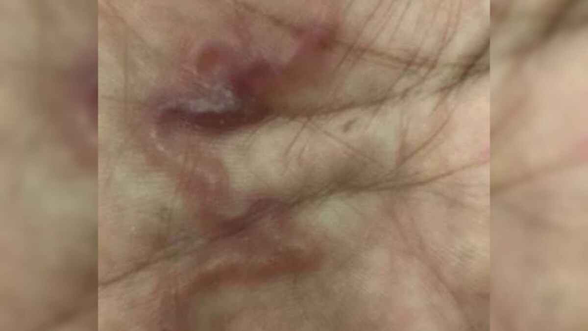 Doctors Find Worms Under Woman's Skin After She Ate... - Vimarsana News