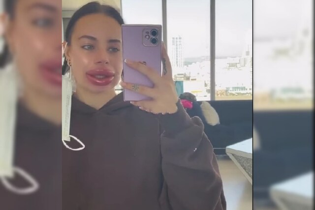 Influencer Ends Up With Massively Swollen Lips After Free Surgery Goes ...