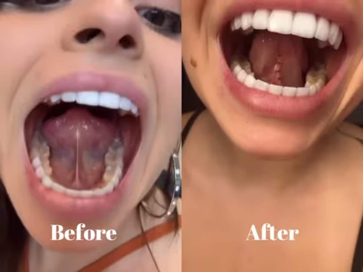 Instagram Influencer Gets Part Of Her Tongue Removed To Kiss Better -  News18
