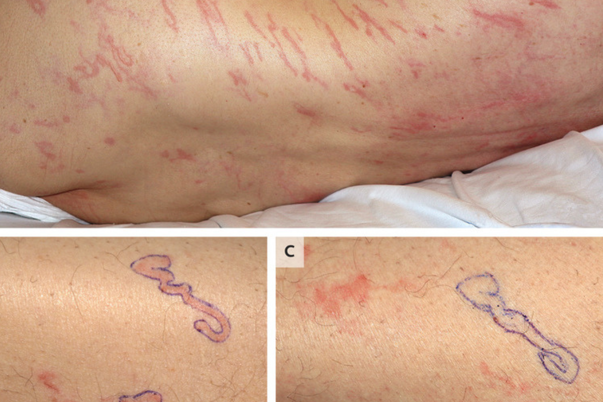 Worms seen crawling under man's skin in a rare case in Spain