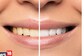 6 Different Cosmetic Dentistry Procedures And Their Benefits