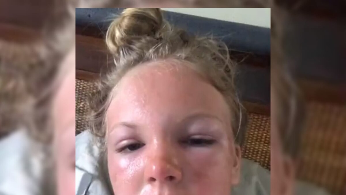 Woman Forgot To Wear Sunscreen To The Beach, Ended Up With A Swollen Face - Vimarsana News