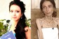 Russian Woman Starves Herself To 22 Kg After Husband's Plump Cheeks Remark, Hospitalised