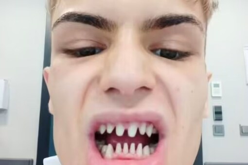'My Teeth Look Like A Shark Tooth Now': Model Who Paid Rs 3 Lakh For