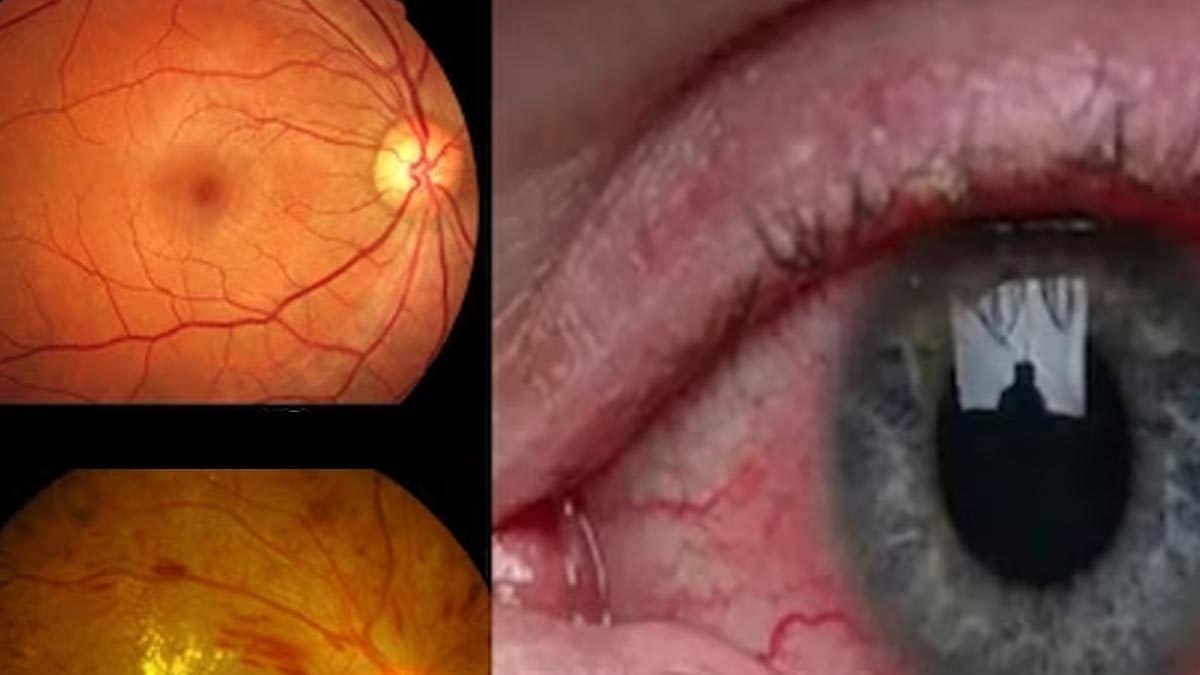 Diabetic Retinopathy: All the pieces You Ought to Know – News18