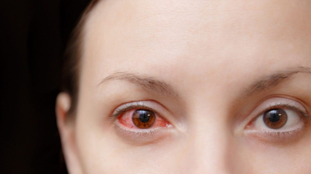 Understanding Conjunctivitis: Causes, Symptoms, Treatment, and Prevention