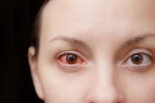 ‘Conjunctivitis Surge an Epidemic’: Doctors Say Infections Likely to Peak Soon | All You Need to Know ‘Conjunctivitis Surge an Epidemic’: Doctors Say Infections Likely to Peak Soon | All You Need to Know