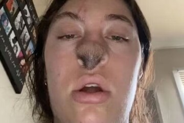 Dog Bites Off 20-year-old's Nose, Now She Has Hair Growing On Her Face