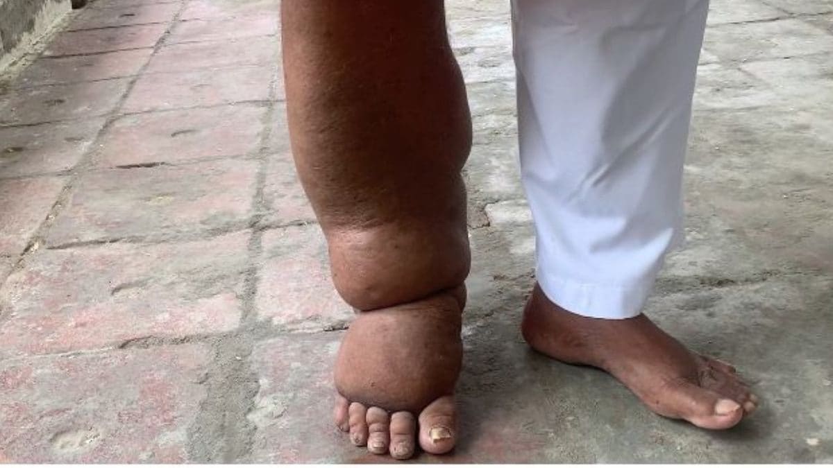 From Snake Oils, Scorpion Bites to Medicines & Awareness: A Look at India's Fight Against Elephantiasis