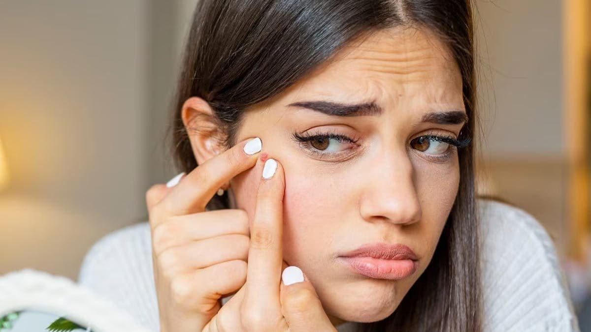 Say Goodbye To Cussed Zits By Following These Efficient Ideas – News18