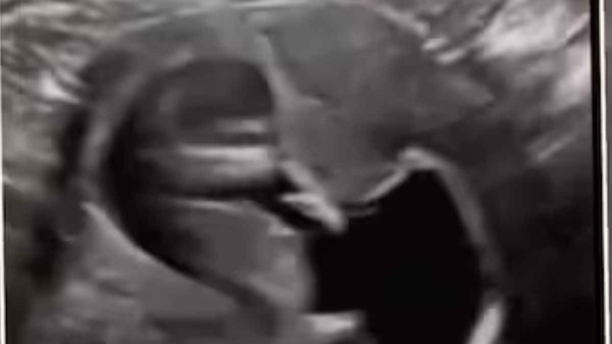 Watch: Ten-week-old Foetus Amazes Internet With Adorable Hiccups