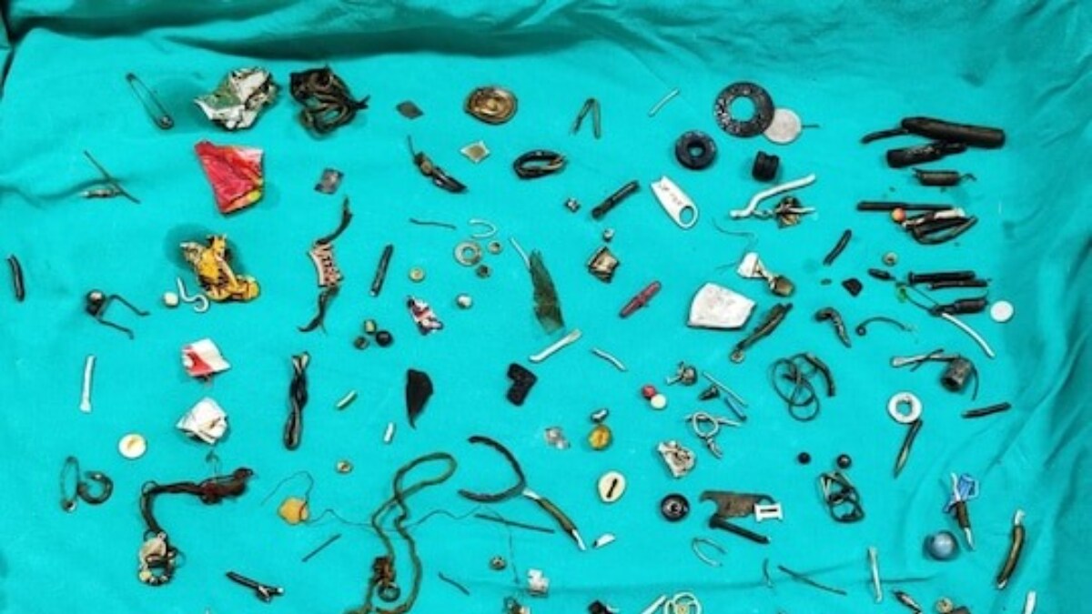 Doctors Remove Earphones, Magnets, Screws From Punjab Man's Stomach - Vimarsana News