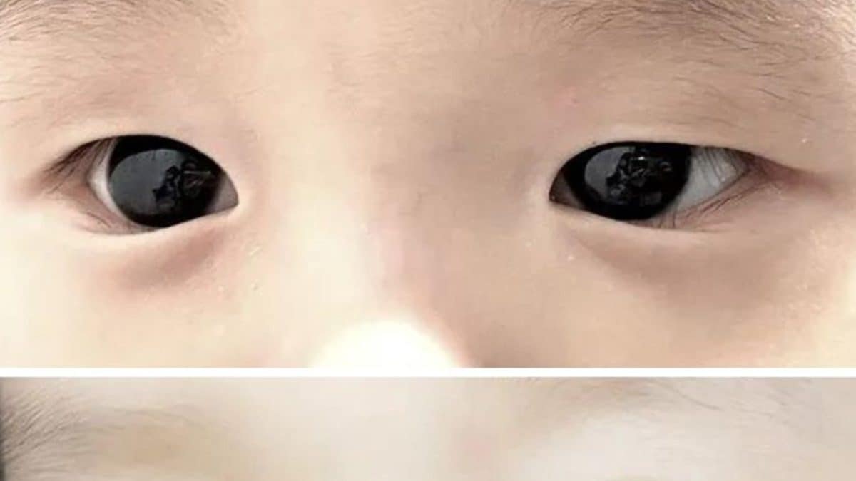 in-rare-complication-baby-s-brown-eyes-turn-blue-after-covid-19