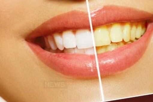 Use Baking Soda and Hydrogen Peroxide to whiten your teeth. 