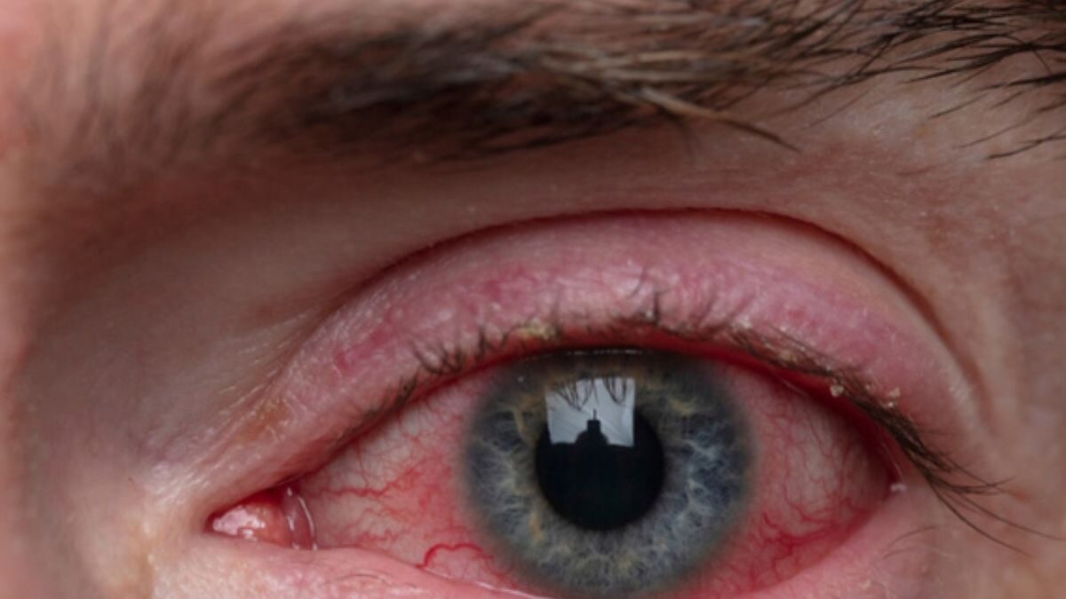 Why Bloodshot Eyes Would possibly Be A Symptom Of Hypertension – News18