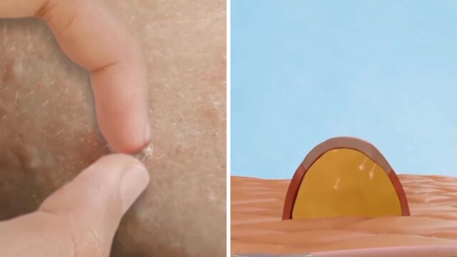 What Happens When You Pop Pimples? Experts Explain The Science Behind