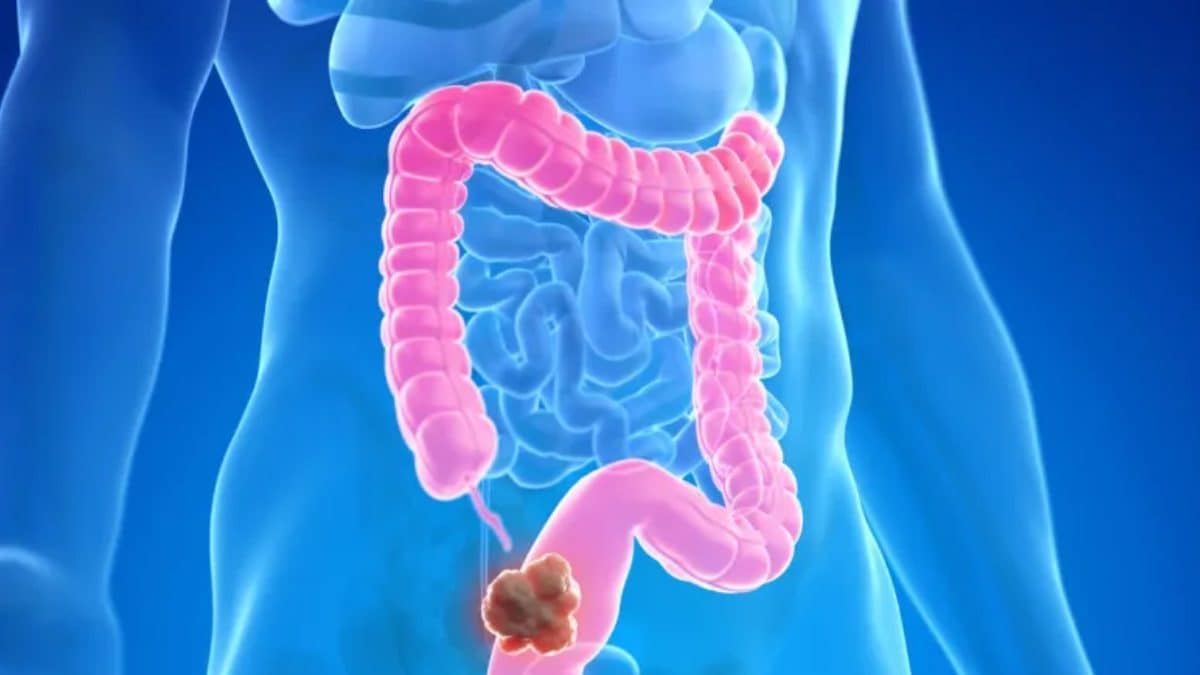 5 Early Signs Of Colon Cancer You Should Never Ignore News18 5 Early Signs Of Colon Cancer You Should Never Ignore News18