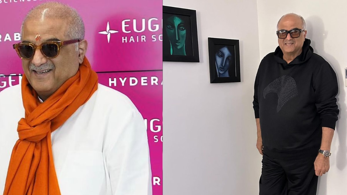 Boney Kapoor Gets Hair Transplant: 5 Things To Know Before Getting The Procedure Boney Kapoor Gets Hair Transplant: 5 Things To Know Before Getting The Procedure