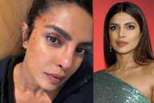Priyanka Chopra Gets Injured on Heads of State Set, Shares Photo Of Bloodied Forehead | See Here