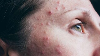How to Cure Pimples at Home; Expert Weighs In - Vimarsana News