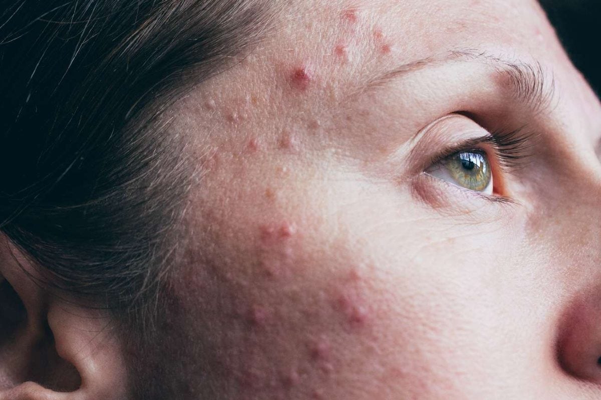 How to Cure Pimples at Home; Expert Weighs In