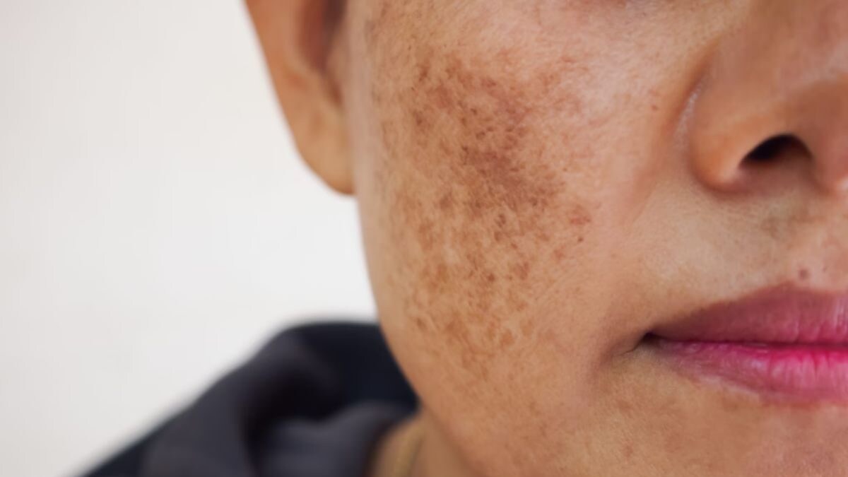 Tired Of Melasma? Know Its Causes And The Remedies