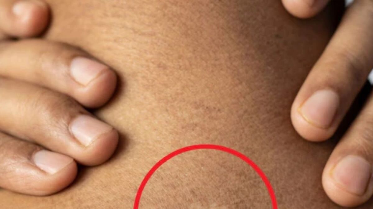 White Patches On Skin? Here's What It Might Indicate - Vimarsana News