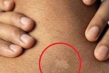White Patches On Skin? Here’s What It Might Indicate
