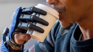 Man, Whose Hand Was Crushed By Meat Grinder, Gets Bionic 3D-Printed Fingers - Vimarsana News