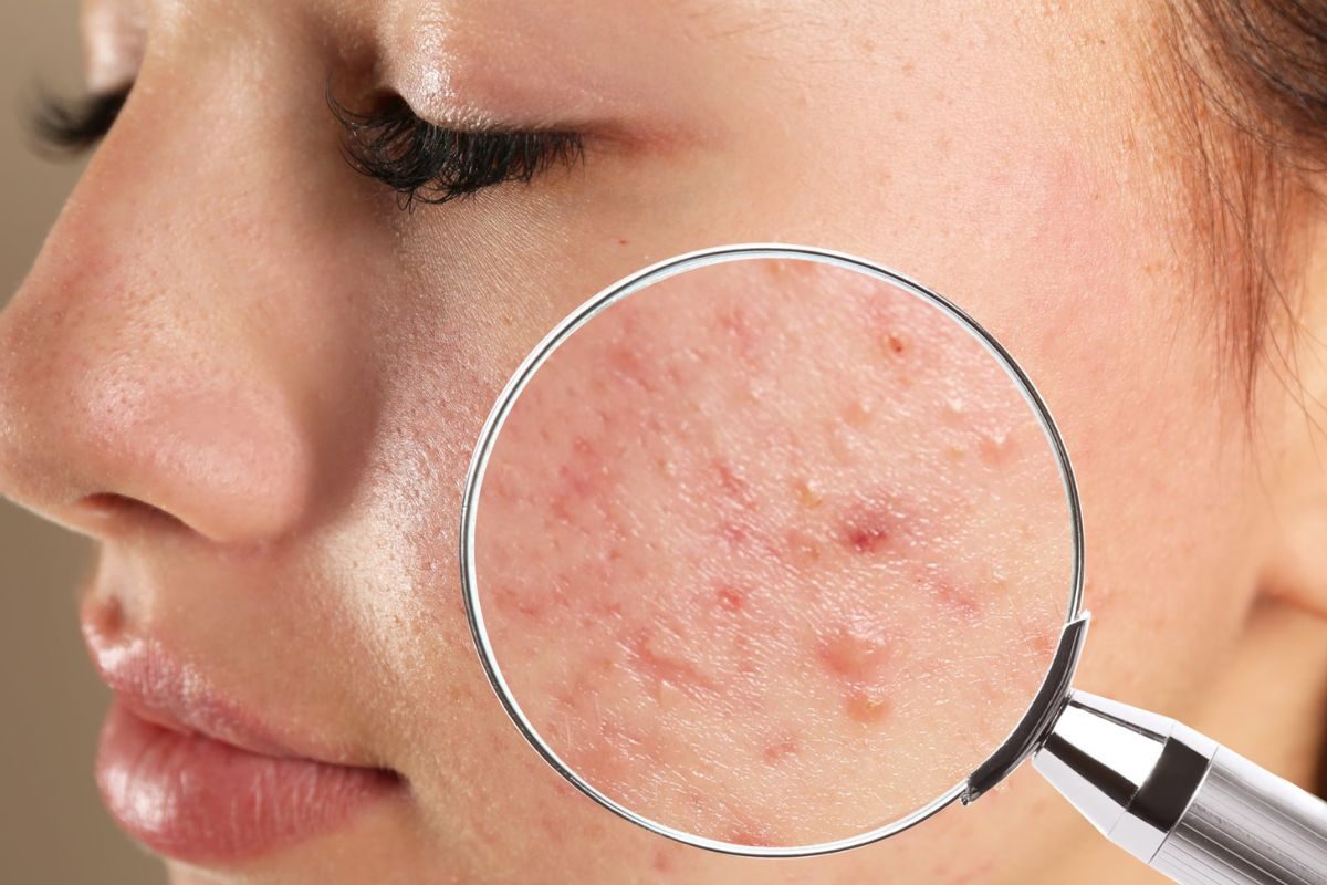 Adding Probiotics To Avoiding Processed Foods, Dietary Habits For Acne Free Skin