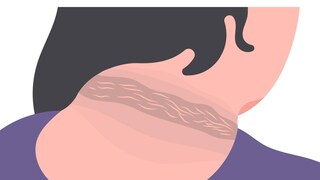 Combating Pre-Diabetic Pigmentation: Unveiling Treatment Options - Vimarsana News