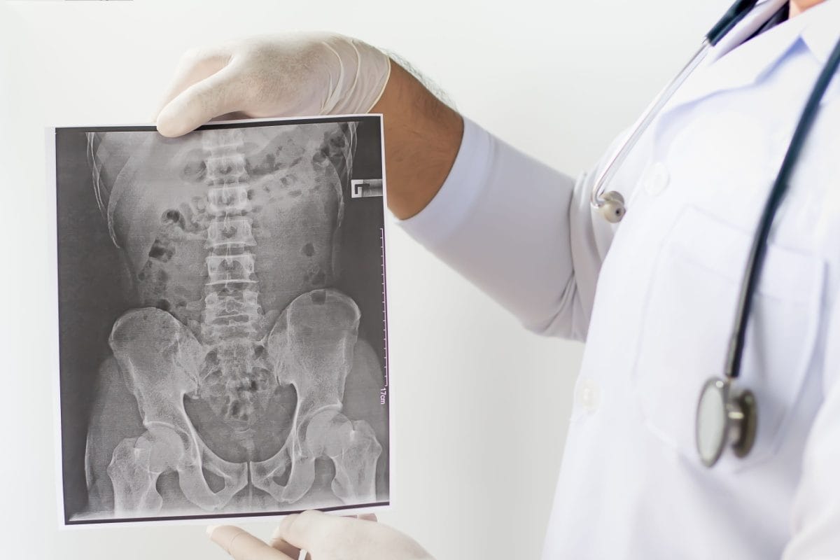 What is Ankylosing Spondylitis And Why Is This Condition Known As A Youngster's Disease?