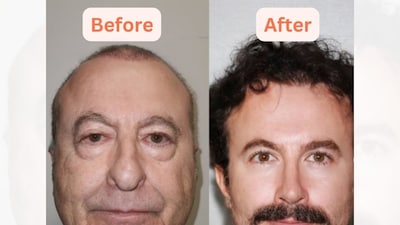 Turkish People are Turning '30 Years Younger' With Jaw-dropping Surgery