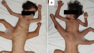 Indonesia: Rare Conjoined Twins' Mobility Restored Through Complex Bone Surgery - Vimarsana News