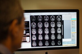 Alzheimer’s Disease, dementia