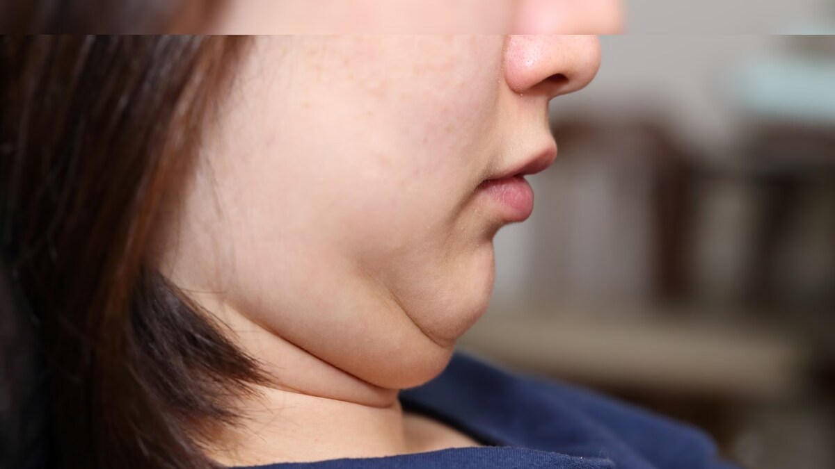 4 Easy Tips To Reduce Your Double Chin – News18 4 Easy Tips To Reduce Your Double Chin – News18