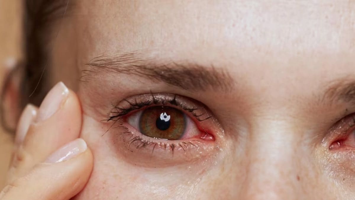 Common Eye Infections During Monsoon And Their Treatments